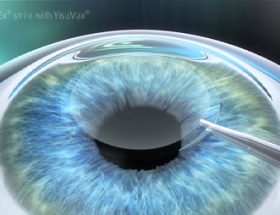 So sánh các phương pháp phẫu thuật laser cận thị hiện nay